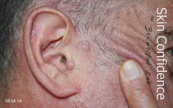 Face lift scar after MCA Micro Needling